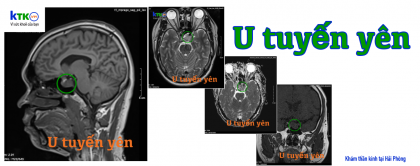 U tuyến yên biểu hiện như nào?